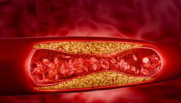 Blocked,Artery,Filled,With,Accumulation,Of,Fat,,Cholesterol,Plaques,,Blood